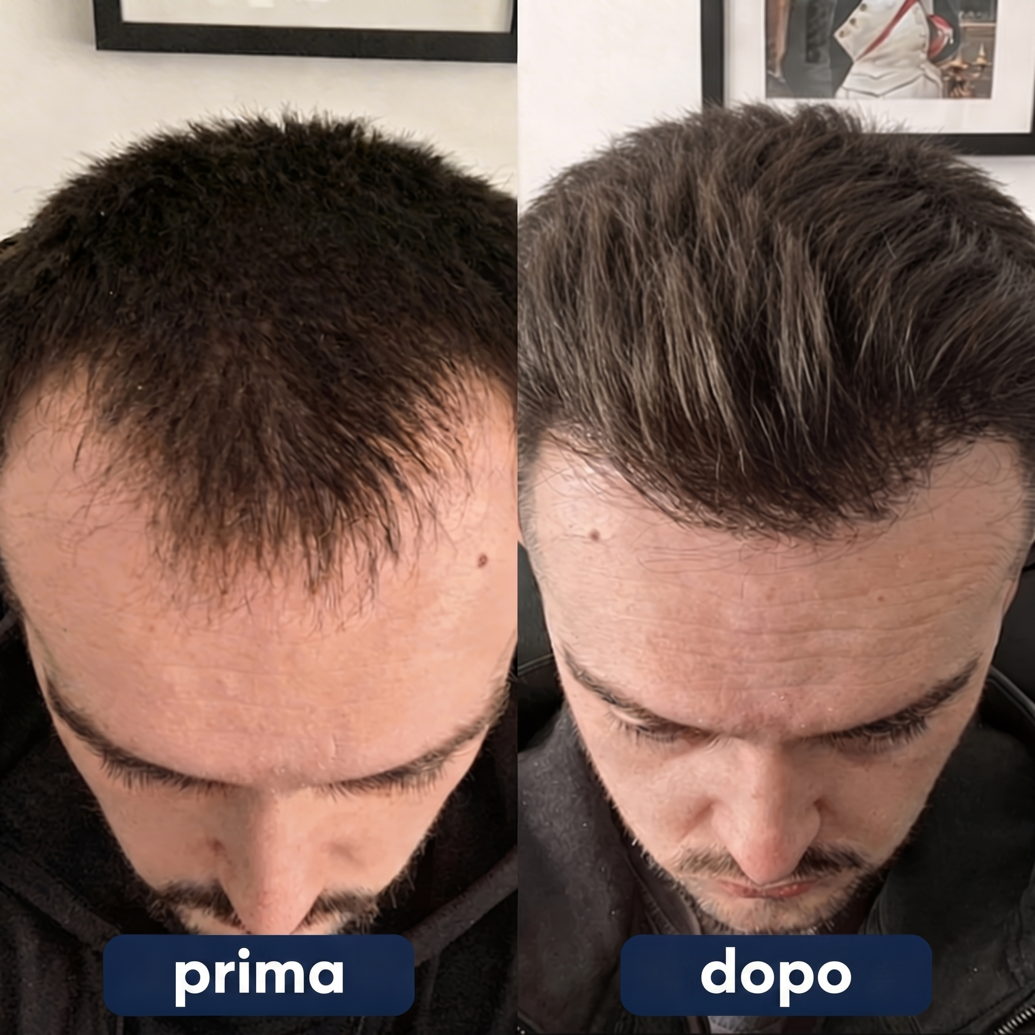 SEREVIA - SIERO RICRESCITA CAPILLARE