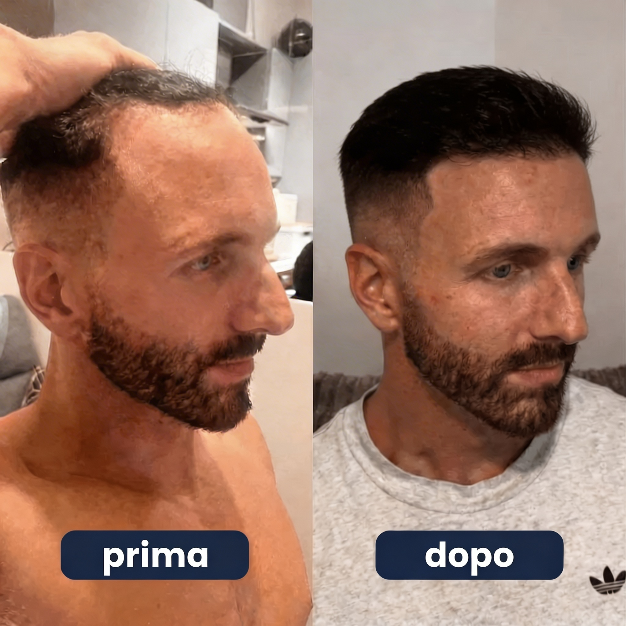 SEREVIA - SIERO RICRESCITA CAPILLARE