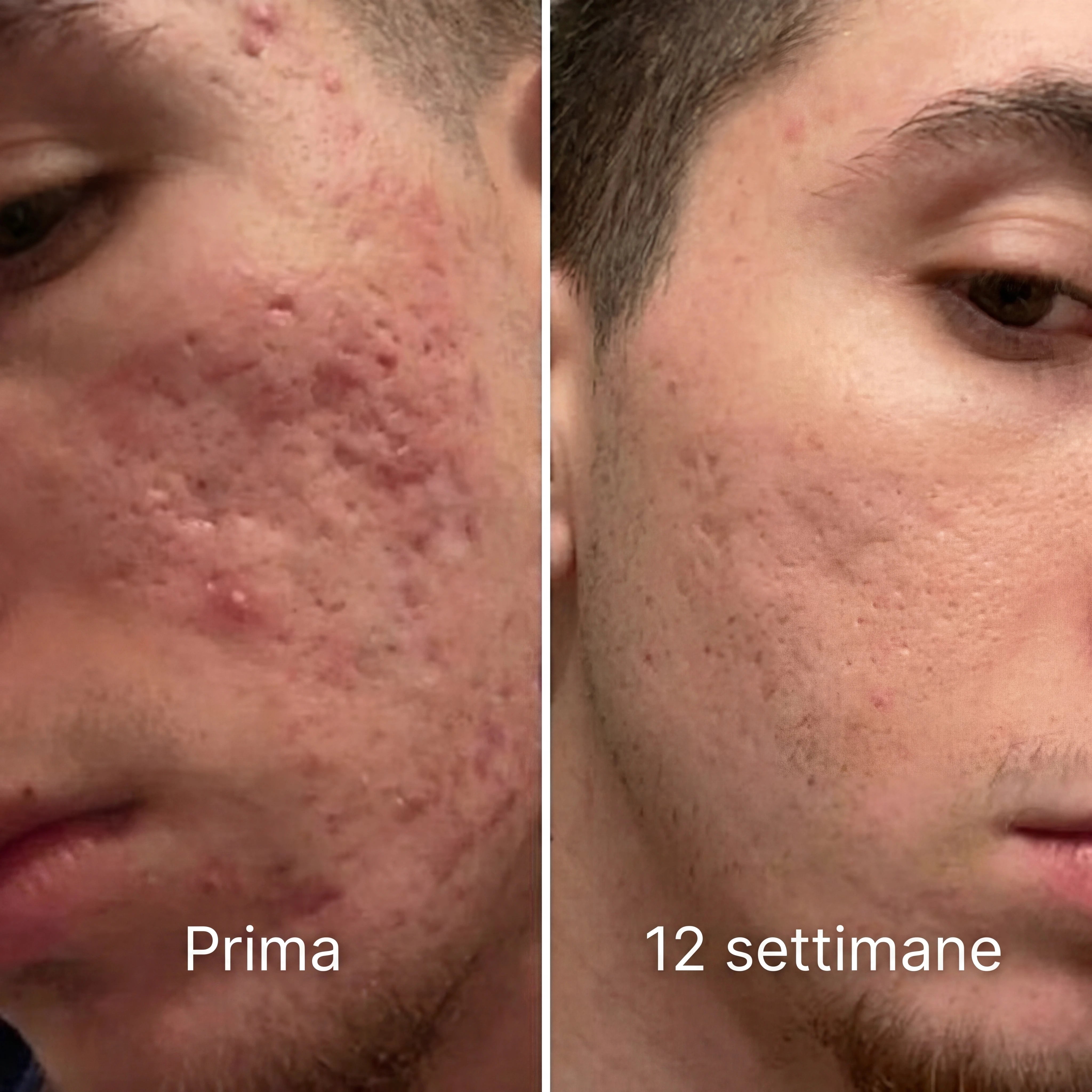 Barriera Riparatrice Invisibile per Cicatrici da Acne™