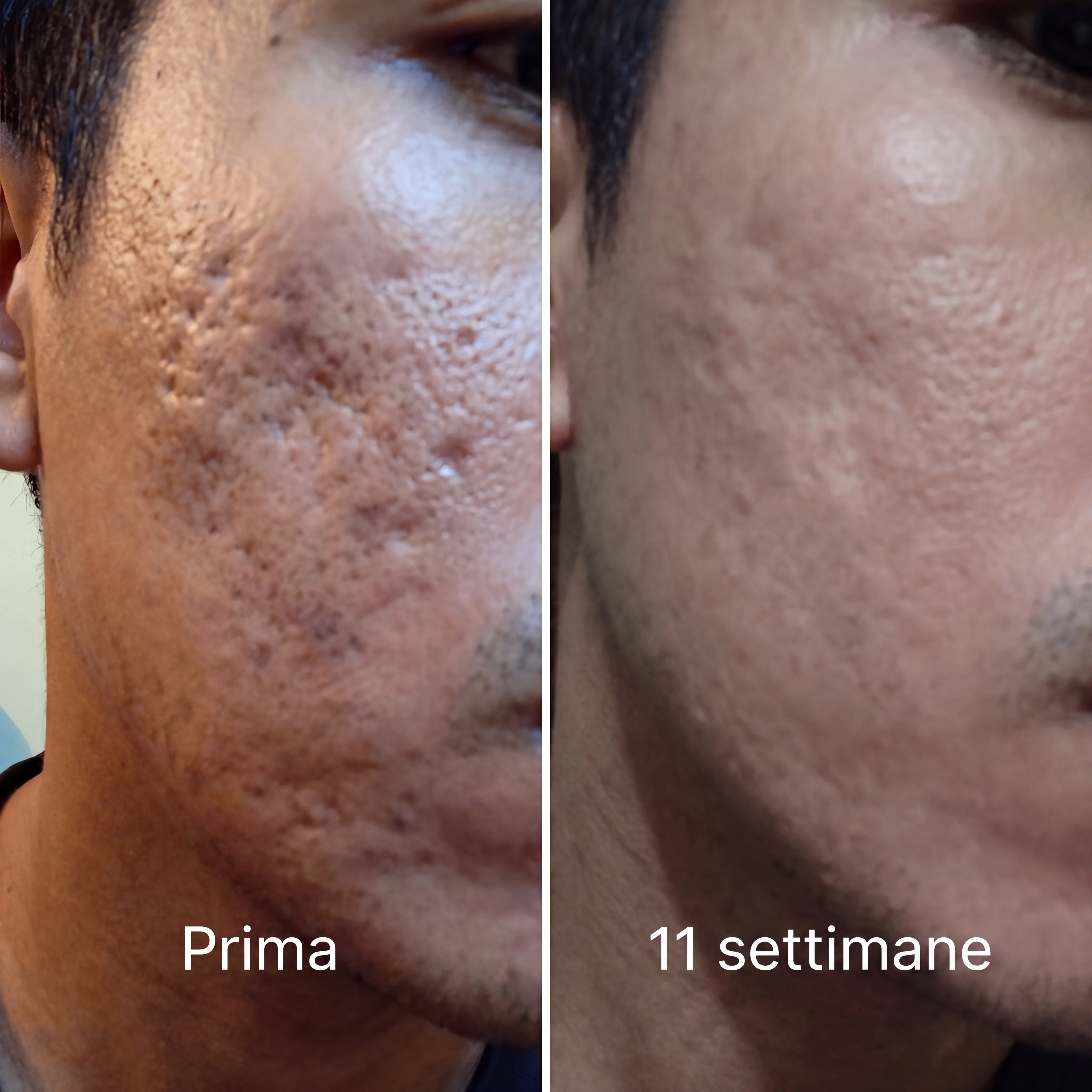 Barriera Riparatrice Invisibile per Cicatrici da Acne™