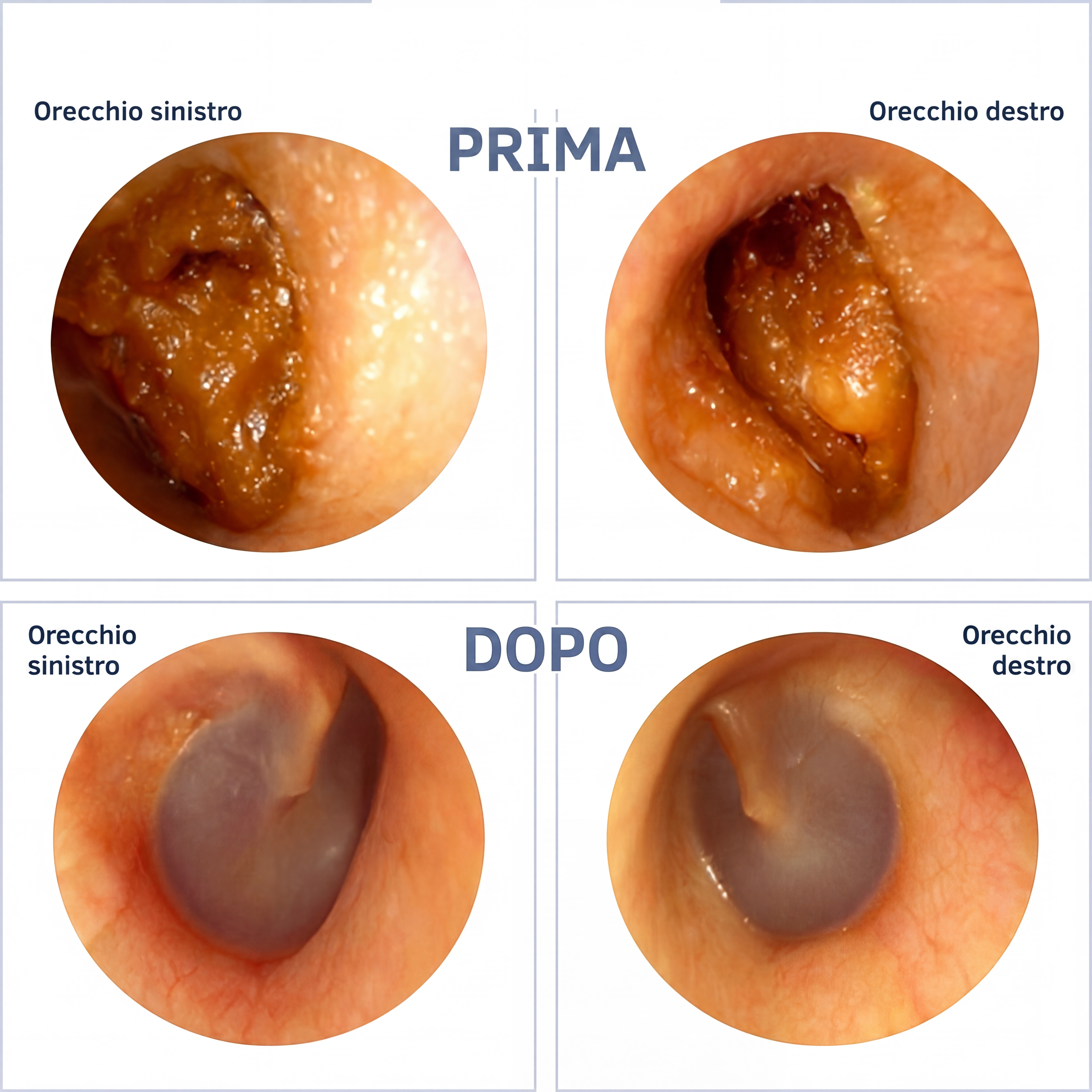 Serevia™ – Pulizia auricolare slim con tecnologia avanzata
